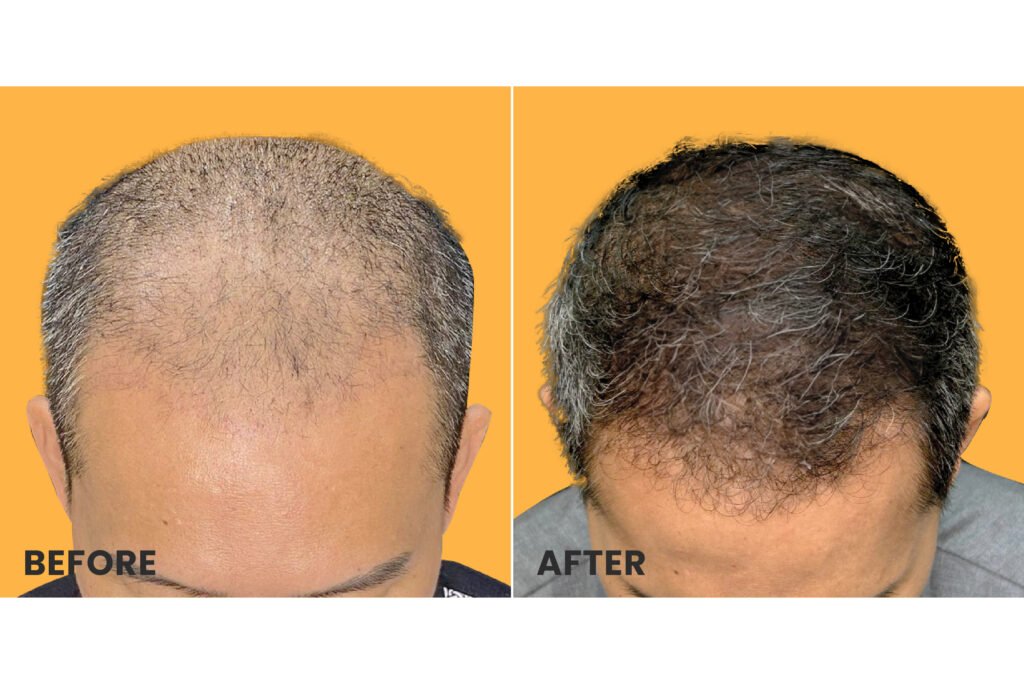 before after hair transplant