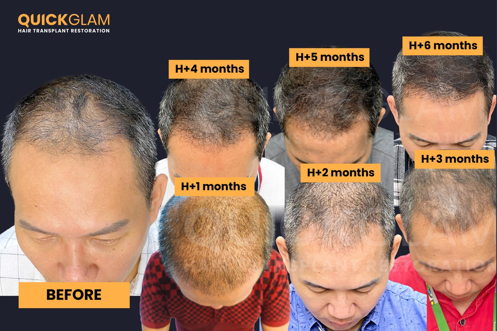 hair transplant process h+1 month 6 month